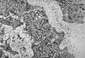 M,12y. | plexus papilloma M,12y. | plexus papilloma